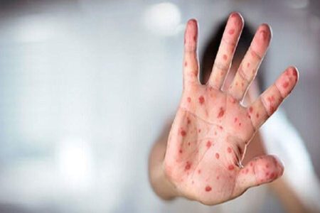 سرخک بیماری واگیردار و در آستانه حذف