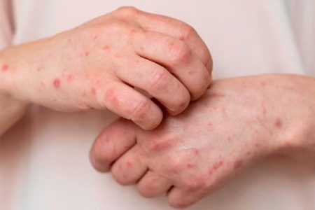 هوای پاییزی عامل افزایش ابتلا به آبلهمرغان